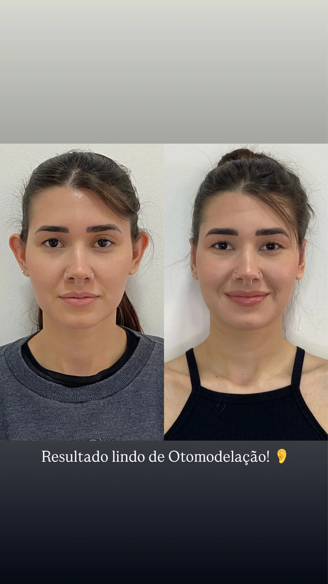 Story de resultado de Otomodelação no formato amador