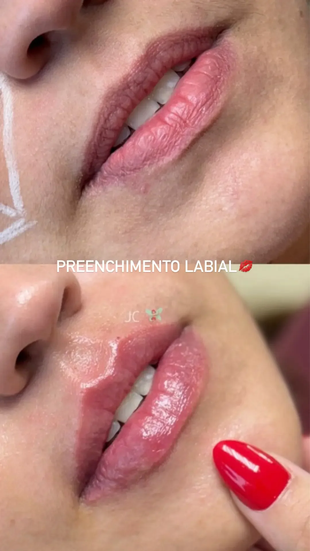 Story de Preenchimento Labial no formato amador