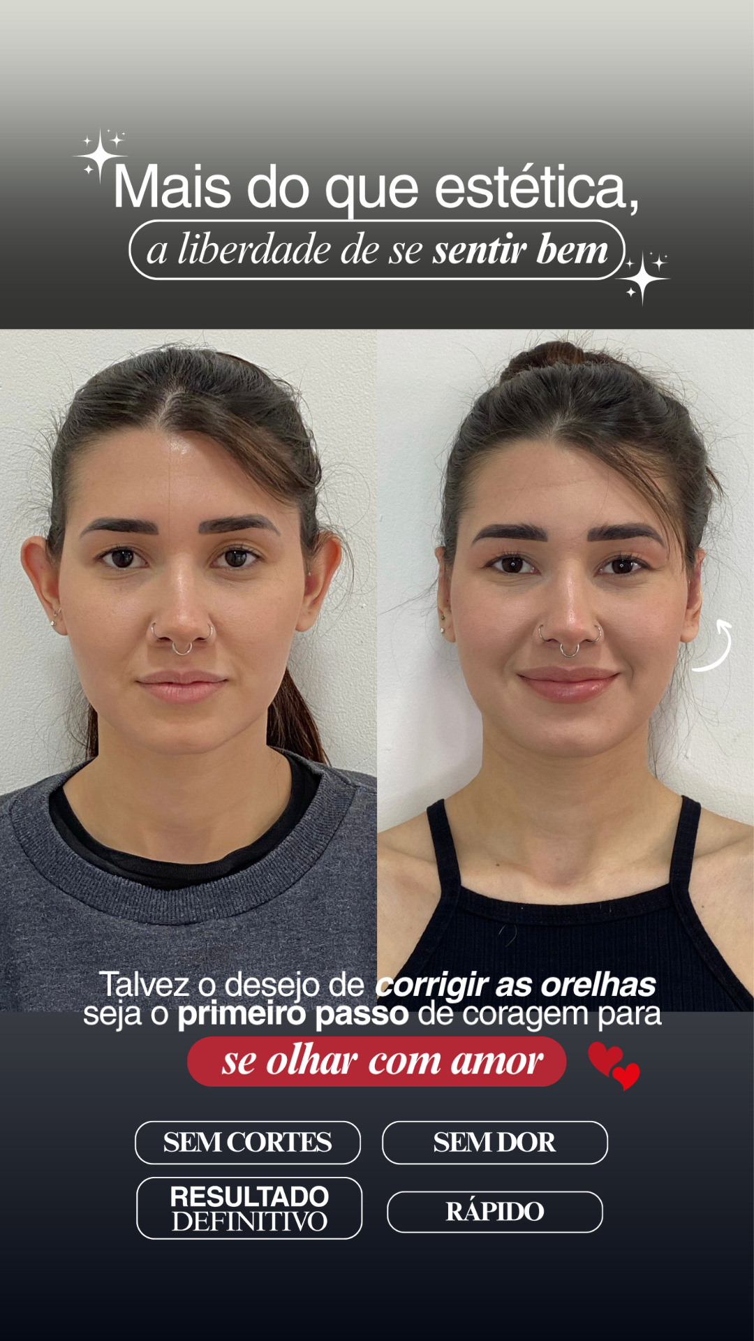 Story de resultado de Otomodelação no formato estratégico StoryHOF