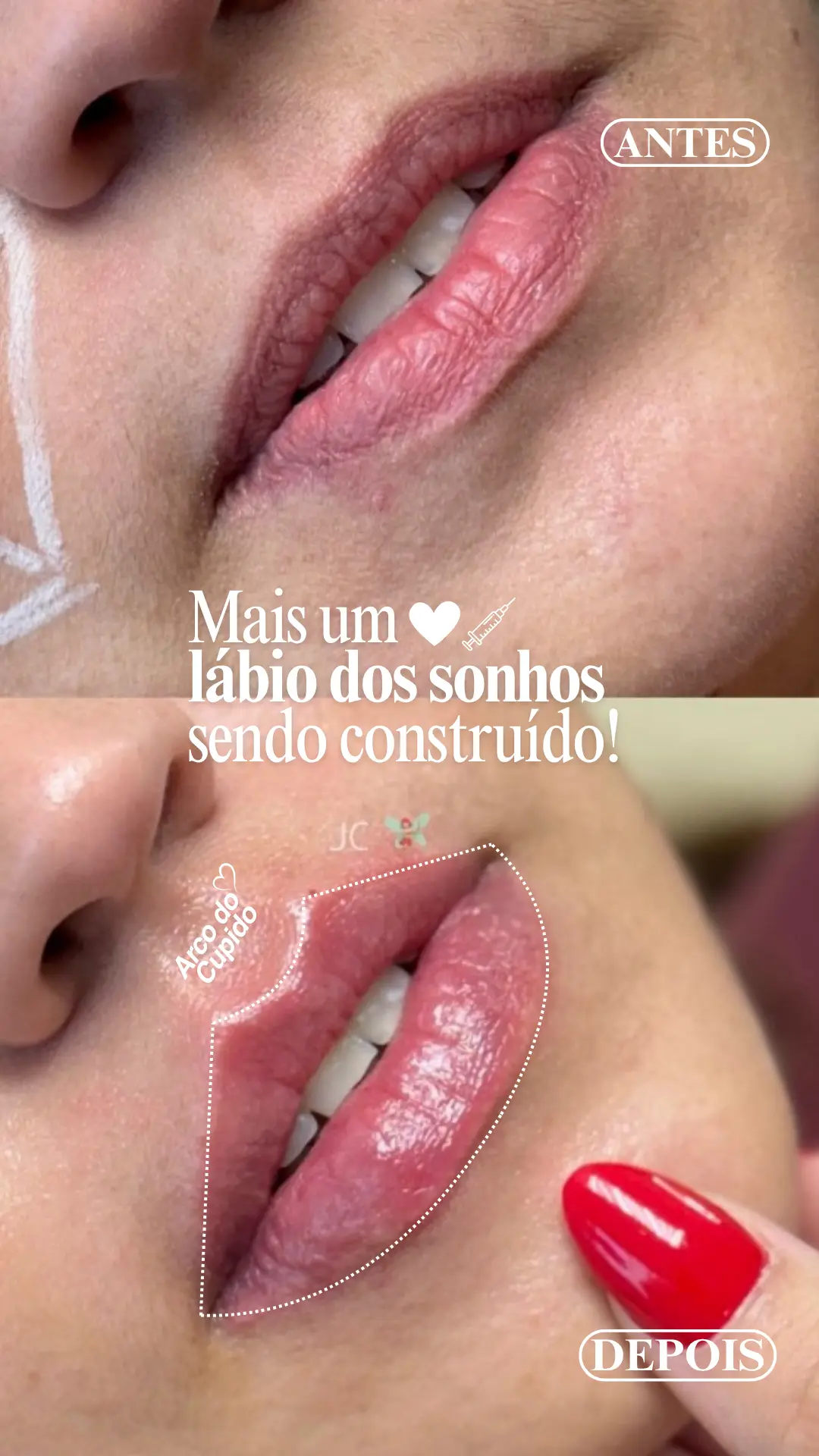 Story de Preenchimento Labial no formato estratégico StoryHOF